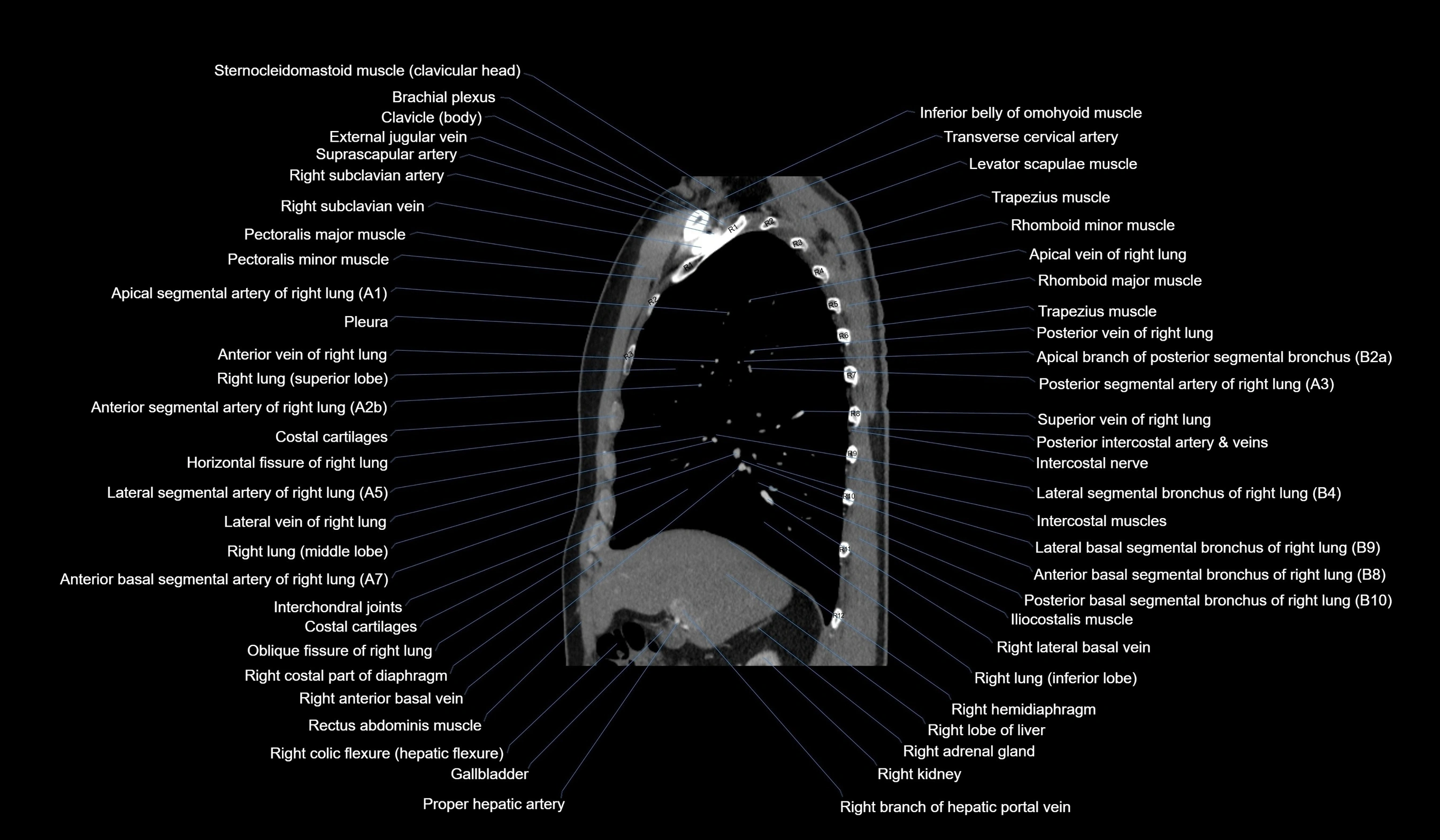 CT chest (thorax) soft tissue window labelled sagittal cross sectional anatomy radiology image-00049.webp
